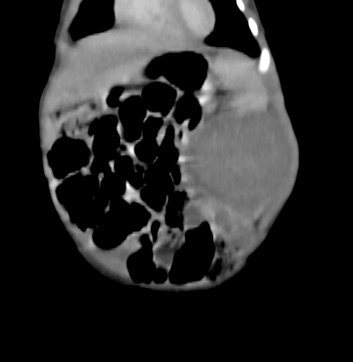 Nephroblastomatosis (Radiopaedia 71294-81607 B 90).jpg