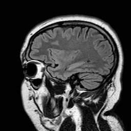 File:Neuro-Behcet's disease (Radiopaedia 21557-21506 Sagittal FLAIR 8).jpg