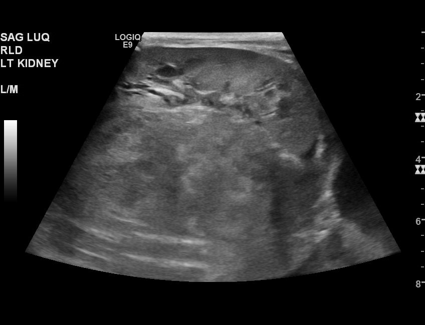 Neuroblastoma (Radiopaedia 47939-52718 Cine Clip 48).jpg