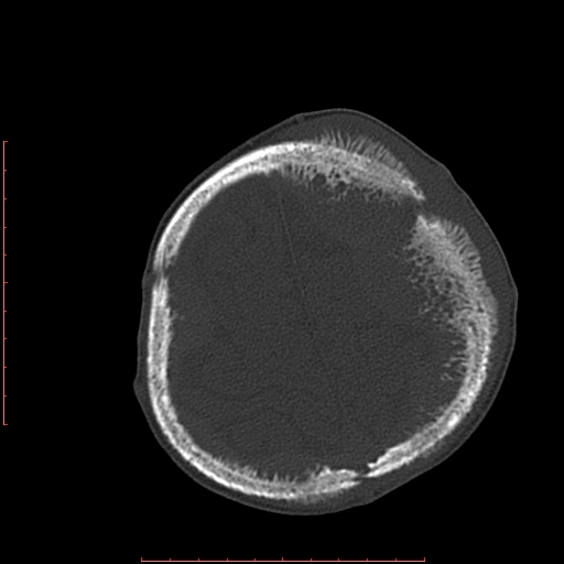 File:Neuroblastoma skull metastasis (Radiopaedia 56053-62683 Axial bone window 22).jpg
