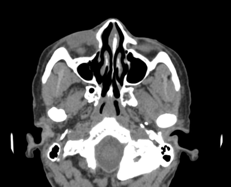 Neurofibromatosis type 1- orbital manifestations (Radiopaedia 49391-54511 Axial non-contrast 33).jpg