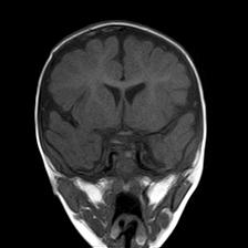 File:Neurofibromatosis type 1 (Radiopaedia 30089-30671 Coronal T1 12).jpg
