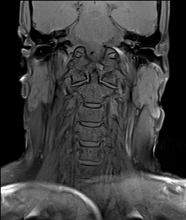File:Neurofibromatosis type 1 (Radiopaedia 80355-93740 Coronal T1 4).jpg