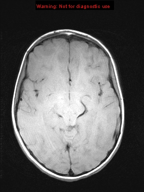 File:Neurofibromatosis type 1 with optic nerve glioma (Radiopaedia 16288-15965 Axial T1 14).jpg