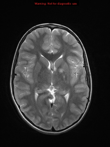 File:Neurofibromatosis type 1 with optic nerve glioma (Radiopaedia 16288-15965 Axial T2 13).jpg