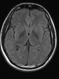 File:Neurofibromatosis type 2 (Radiopaedia 44936-48838 Axial FLAIR 12).png