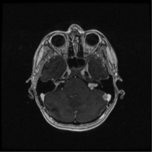Neurofibromatosis type 2 (Radiopaedia 45229-49244 Axial T1 C+ 40).png