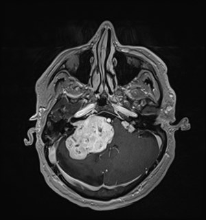 Neurofibromatosis type 2 (Radiopaedia 79097-92049 Axial T1 C+ 56).jpg