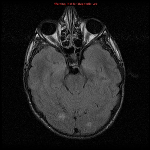File:Neurofibromatosis type 2 (Radiopaedia 8953-9730 Axial FLAIR 10).jpg