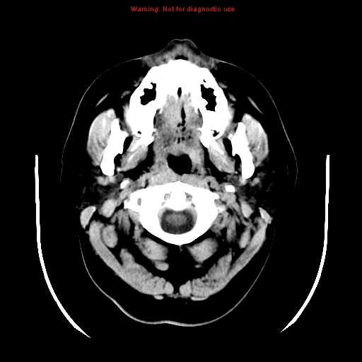 File:Neuroglial cyst (Radiopaedia 10713-11185 Axial non-contrast 32).jpg