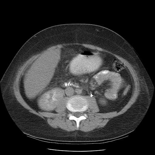 File:Non-Hodgkin lymphoma involving pelvis (Radiopaedia 21281-21197 B 35).jpg