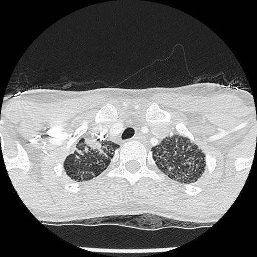 File:Non-small cell lung cancer with miliary metastases (Radiopaedia 23995-24193 Axial lung window 5).jpg