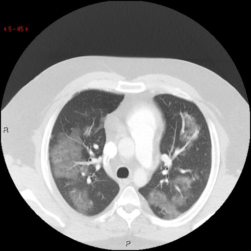 File:Non-specific interstitial pneumonitis (Radiopaedia 27044-27222 Axial lung window 36).jpg