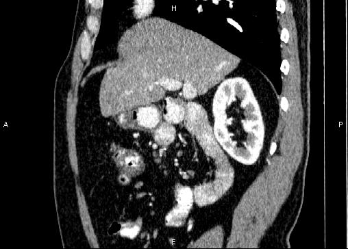 Non-syndromic pancreatic endocrine tumor (Radiopaedia 86958-103178 E 36).jpg