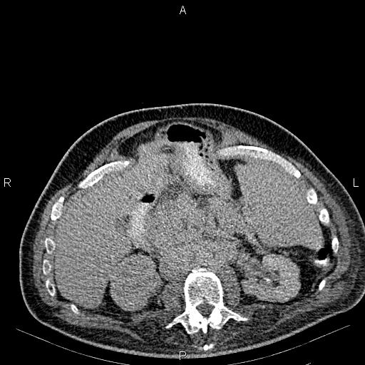 Non Hodgkin lymphoma in a patient with ankylosing spondylitis (Radiopaedia 84323-99621 Axial C+ delayed 27).jpg