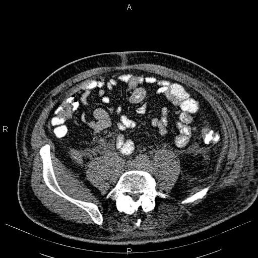 File:Non Hodgkin lymphoma in a patient with ankylosing spondylitis (Radiopaedia 84323-99621 Axial non-contrast 46).jpg