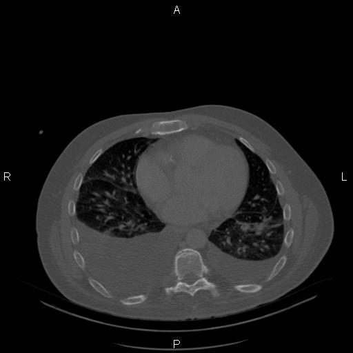Non Hodgkin lymphoma in a patient with ankylosing spondylitis (Radiopaedia 84323-99624 Axial bone window 19).jpg