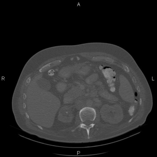 Non Hodgkin lymphoma in a patient with ankylosing spondylitis (Radiopaedia 84323-99624 Axial bone window 35).jpg