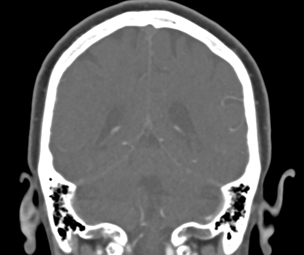 File:Normal CTA head (Radiopaedia 40801-43464 B 67).png