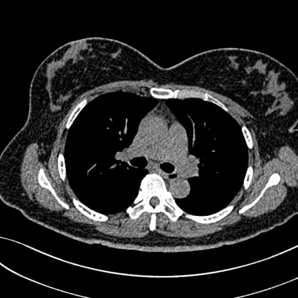 Normal CT chest- adult female (Radiopaedia 52522-58428 Axial non-contrast 55).jpg