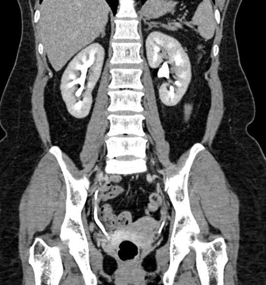 Normal CT intravenous urogram (Radiopaedia 39444-41759 A 302).jpg
