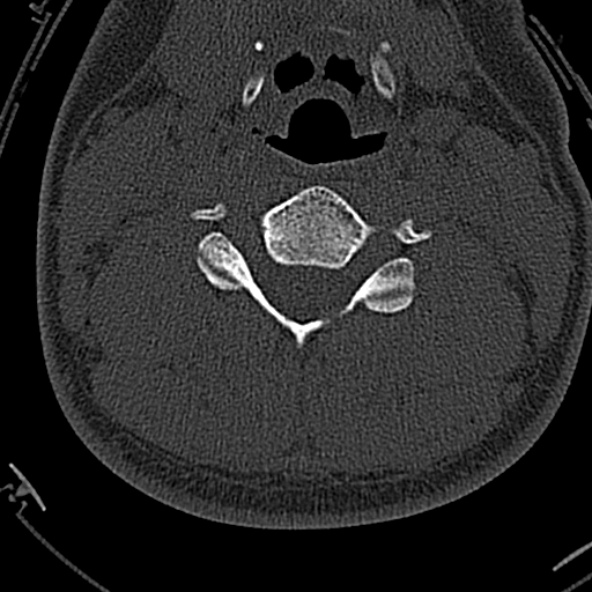 File:Normal CT of the cervical spine (Radiopaedia 53322-59305 Axial bone window 140).jpg