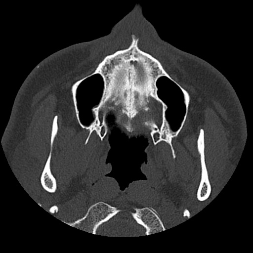 Normal CT paranasal sinuses (Radiopaedia 42286-45390 Axial bone window 92).jpg