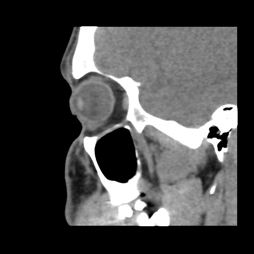 Normal CT paranasal sinuses (Radiopaedia 42286-45390 F 110).jpg