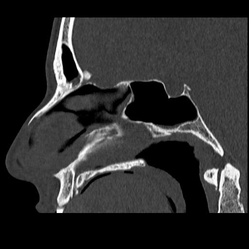 Normal CT paranasal sinuses (Radiopaedia 42286-45390 Sagittal bone window 53).jpg