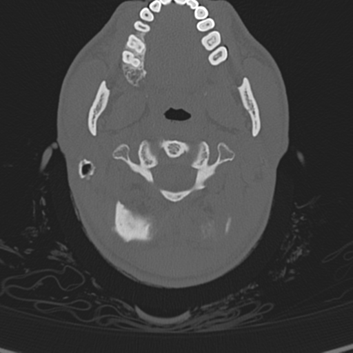 Normal CT skull (Radiopaedia 40798-43459 A 4).png