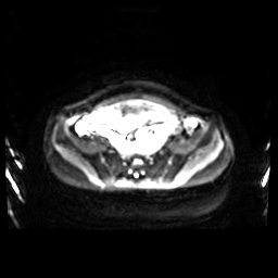 Normal MRI abdomen in pregnancy (Radiopaedia 88001-104541 Axial DWI 12).jpg