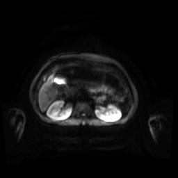 Normal MRI abdomen in pregnancy (Radiopaedia 88001-104541 Axial DWI 79).jpg