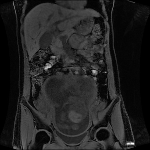 Normal MRI abdomen in pregnancy (Radiopaedia 88001-104541 M 62).jpg