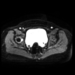 Normal MRI abdomen in pregnancy (Radiopaedia 88005-104548 Axial DWI 14).jpg