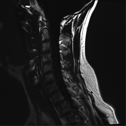 File:Normal MRI cervical spine (infection protocol) (Radiopaedia 53916-60039 F 7).png