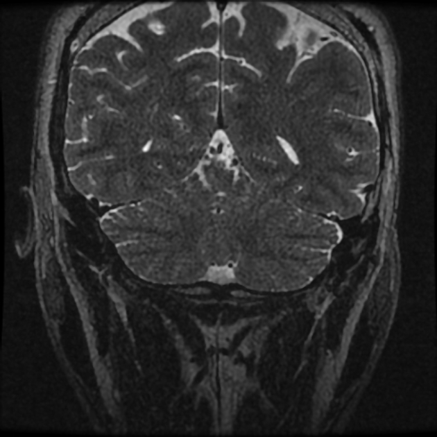 Normal MRI petrous (Radiopaedia 91317-108949 Coronal T2 118).jpg