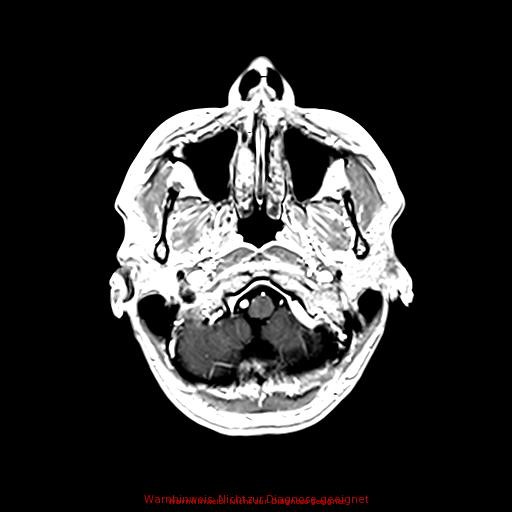 Normal adult brain MRI (non-enhanced and contrast-enhanced) (Radiopaedia 75262-86379 Axial T1 C+ 45).jpg