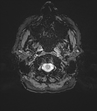 Normal brain MRI (TLE protocol) (Radiopaedia 40748-43405 Axial SWI 2).png