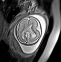File:Normal brain fetal MRI - 22 weeks (Radiopaedia 50623-56050 Axial T2 Haste 5).jpg