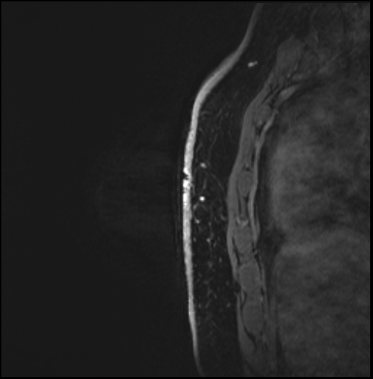 Normal breast MRI - dense breasts (Radiopaedia 80454-93850 I 156).jpg