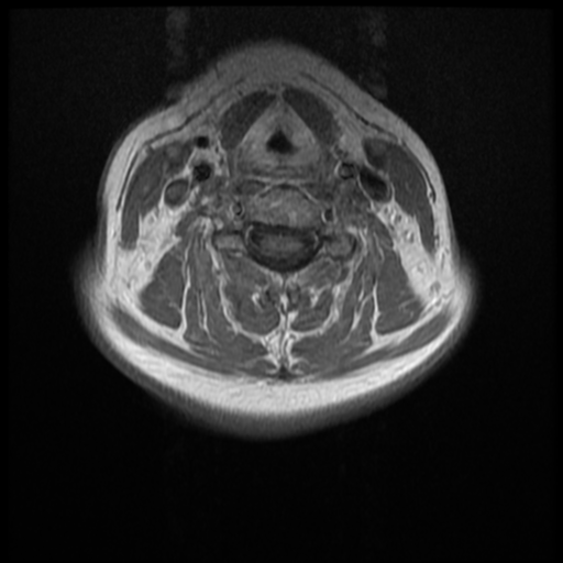 File:Normal cervical and thoracic spine MRI (Radiopaedia 35630-37156 Axial T1 C+ 18).png