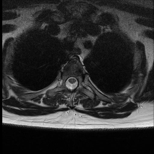 File:Normal cervical and thoracic spine MRI (Radiopaedia 35630-37156 H 35).png