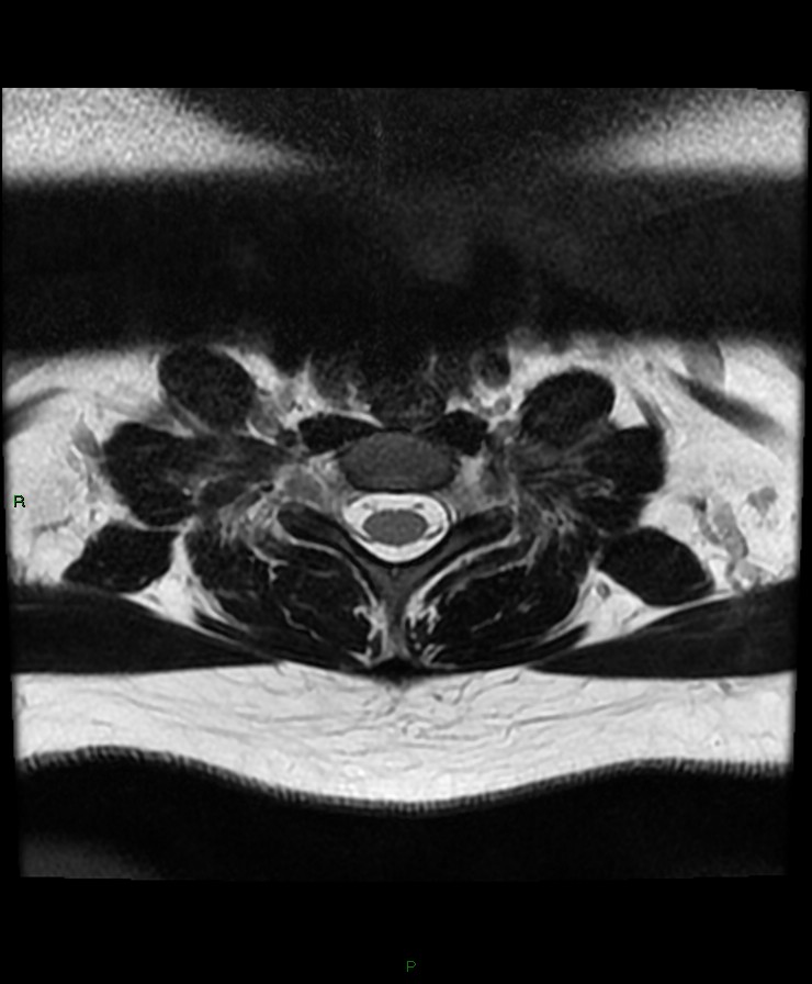 Normal cervical spine MRI (Radiopaedia 80146-93454 Axial T2 84).jpg