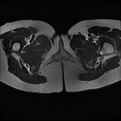 File:Normal female pelvis MRI (retroverted uterus) (Radiopaedia 61832-69933 Axial T2 31).jpg