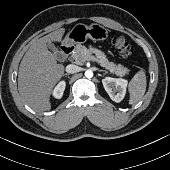 Normal kidneys on 4-phase CT study (Radiopaedia 25889-26038 B 17).jpg