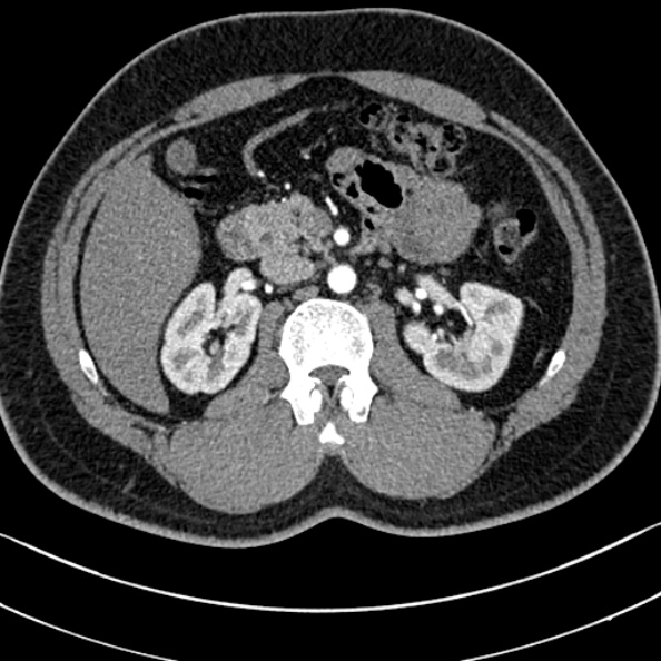 Normal kidneys on 4-phase CT study (Radiopaedia 25889-26038 B 33).jpg
