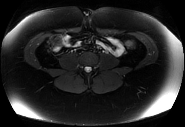 File:Normal liver MRI with Gadolinium (Radiopaedia 58913-66163 Axial T2 fat sat 1).jpg