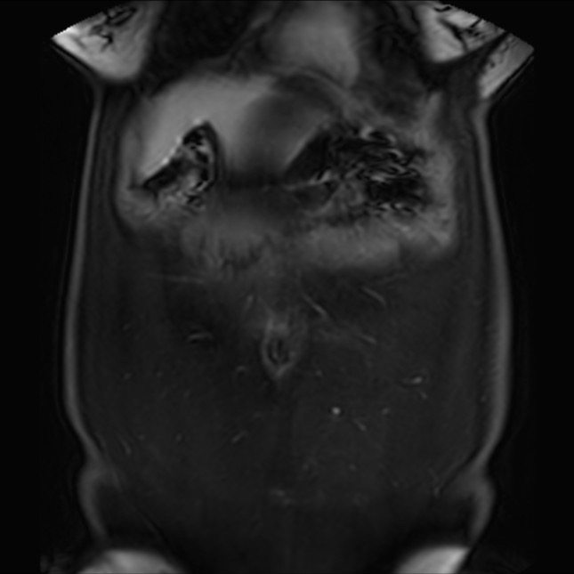 Normal liver MRI with Gadolinium (Radiopaedia 58913-66163 P 16).jpg