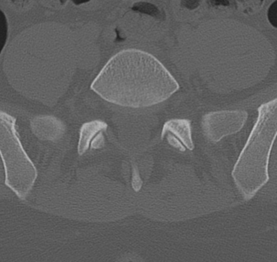 File:Normal lumbar spine CT (Radiopaedia 46533-50986 Axial bone window 63).png