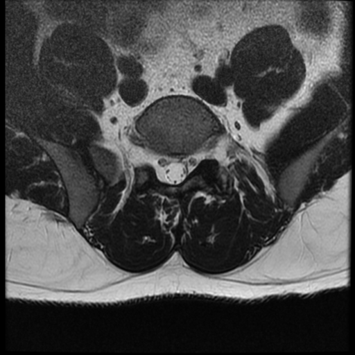 File:Normal lumbar spine MRI (Radiopaedia 35543-37039 Axial T2 8).png